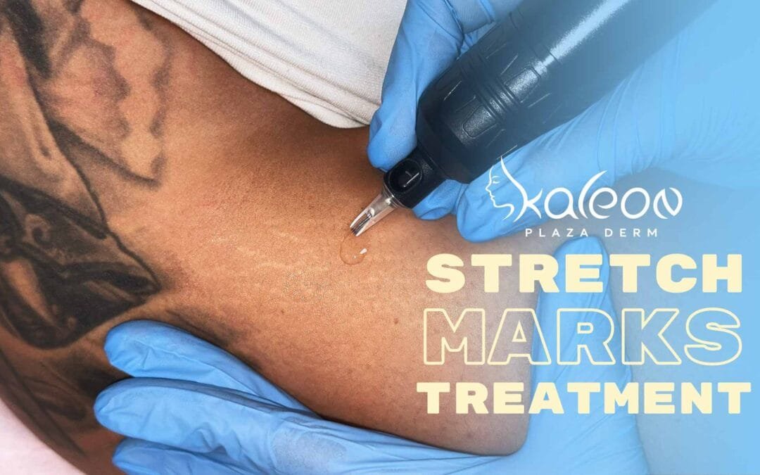 Терапия за трайно лечение на стрии и белези Strach marks removal